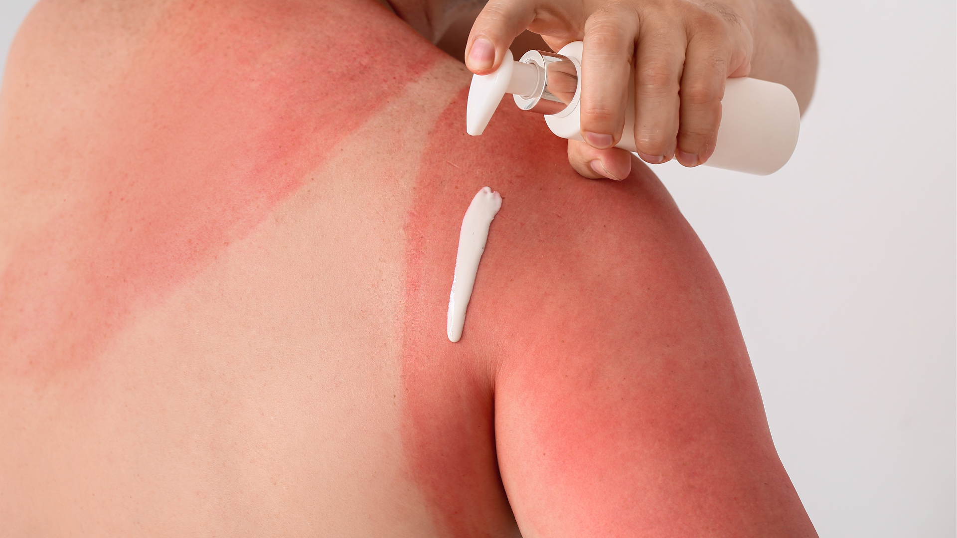 Woman with sunburn putting on lotion